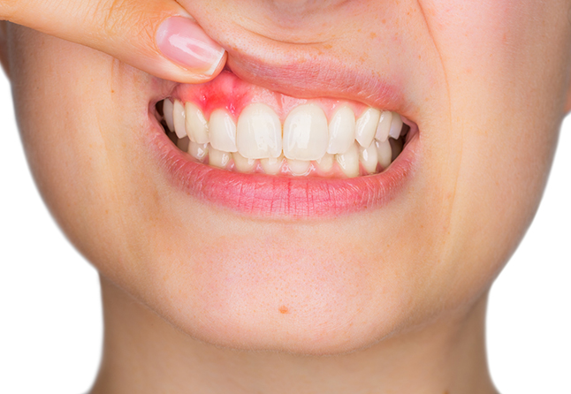 Gum Diseases: Symptoms and Treatment Methods